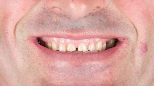 rehabilitacion dental oviedo dentista