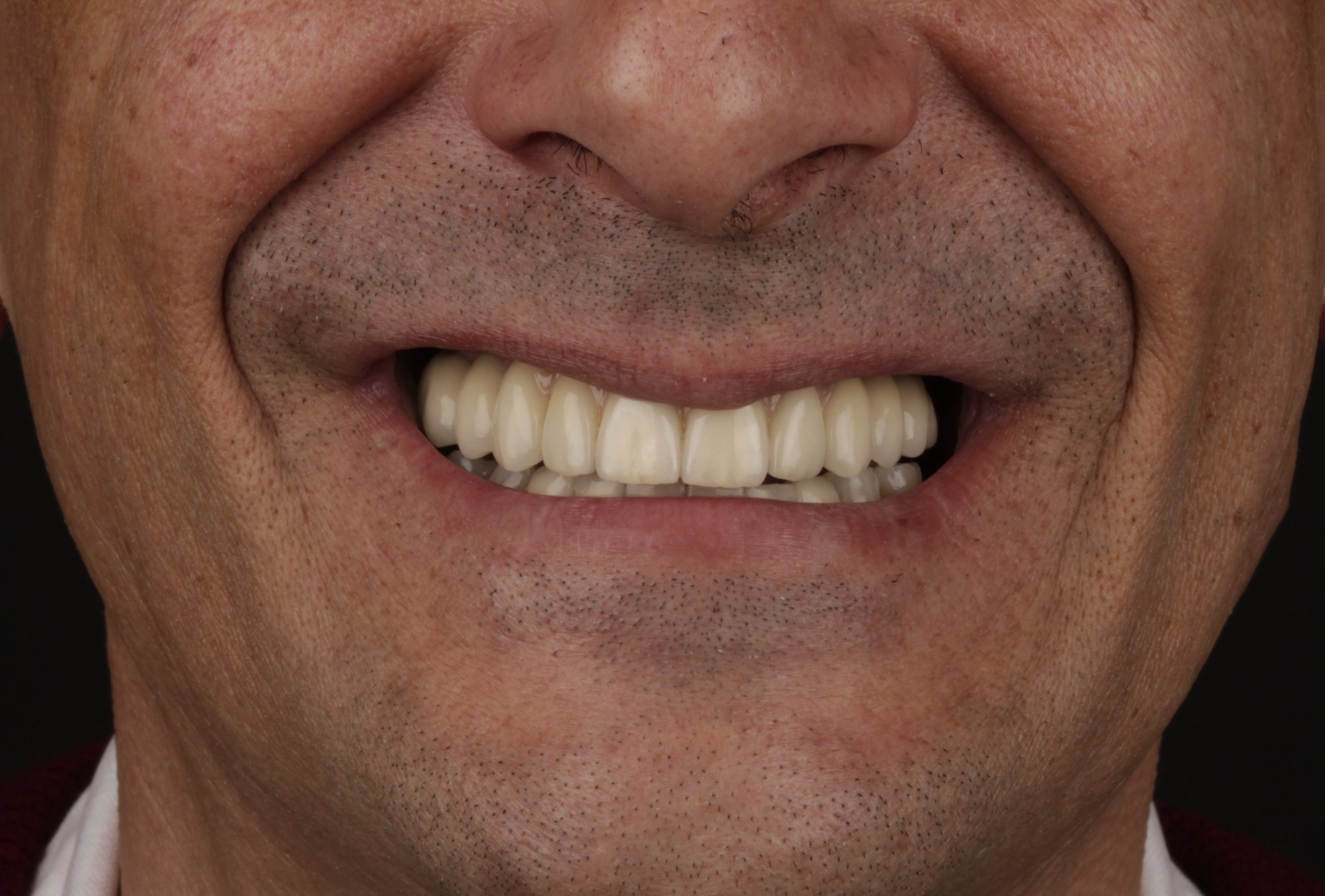 Cuidados Post-Tratamiento de Implantes Dentales