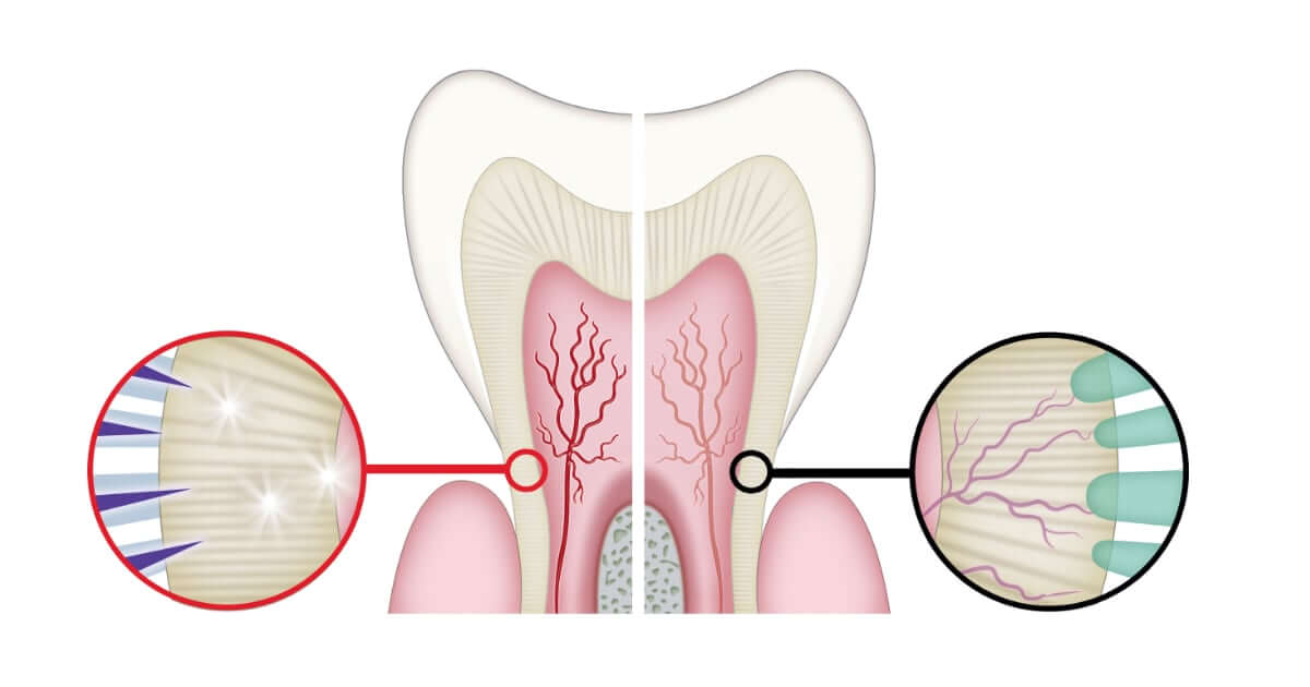 Cómo manejar la hipersensibilidad dental
