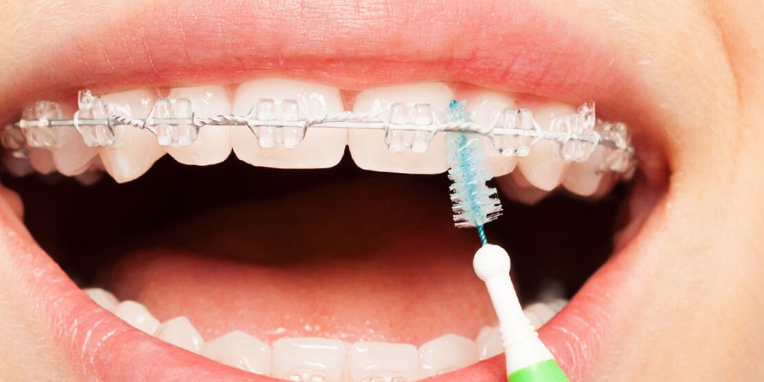 Cómo mantener una buena higiene oral con aparatos ortodónticos