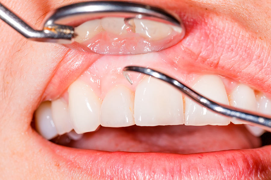 Gingivitis y periodontitis: prevención y tratamiento