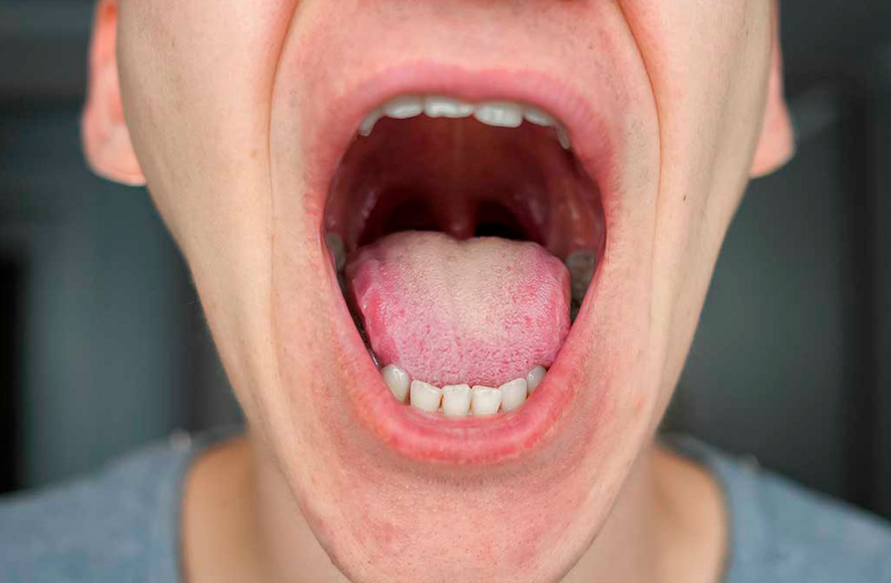 cancer oral