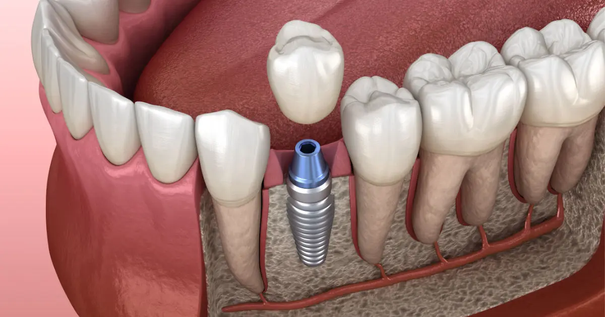 Implantes dentales