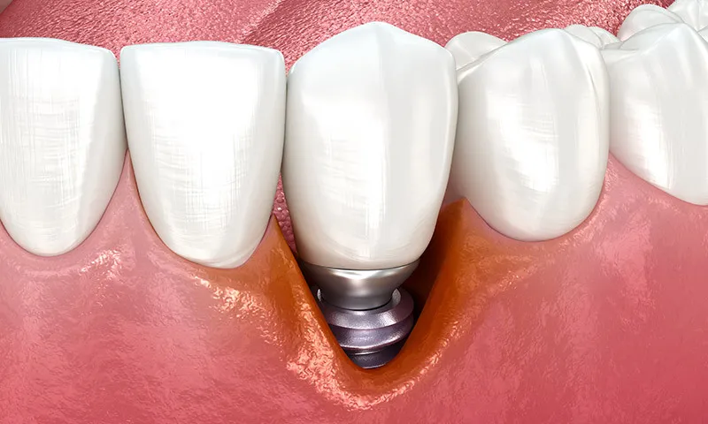 periimplantitis