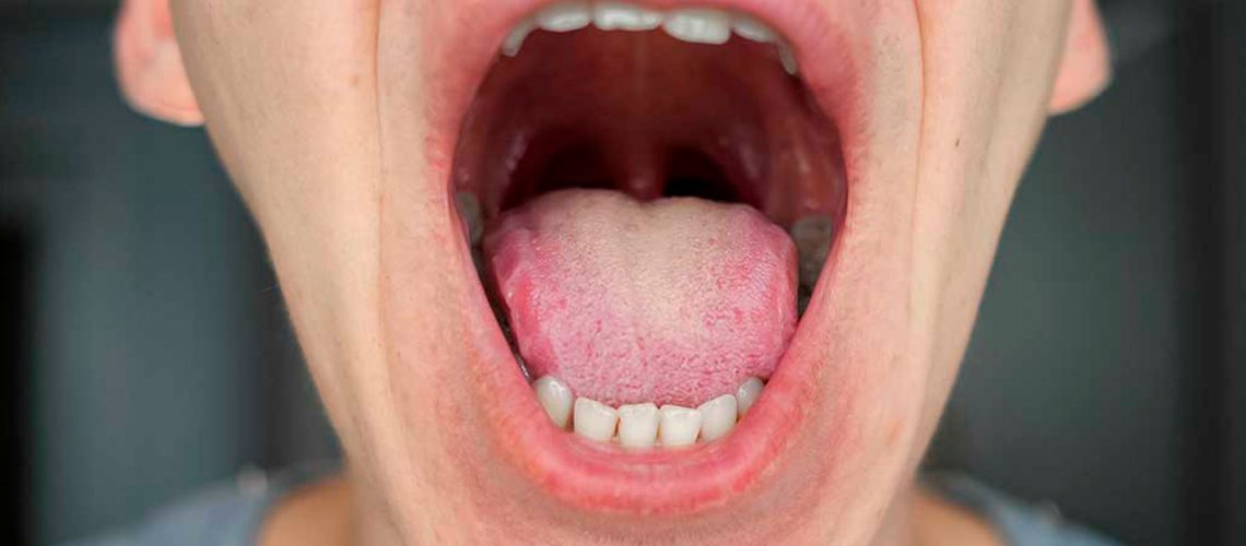 cancer oral