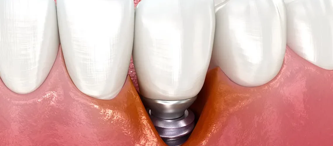 periimplantitis